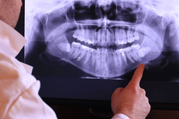 Best Knocked-Out Tooth (Avulsed Tooth) Treatment in Mahtomedi, MN
