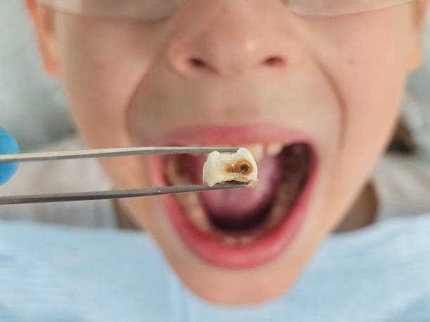 Best Emergency Dental Care for Sports Injuries in Mahtomedi, MN